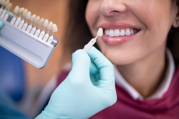 Porcelain Veneers in Dallas