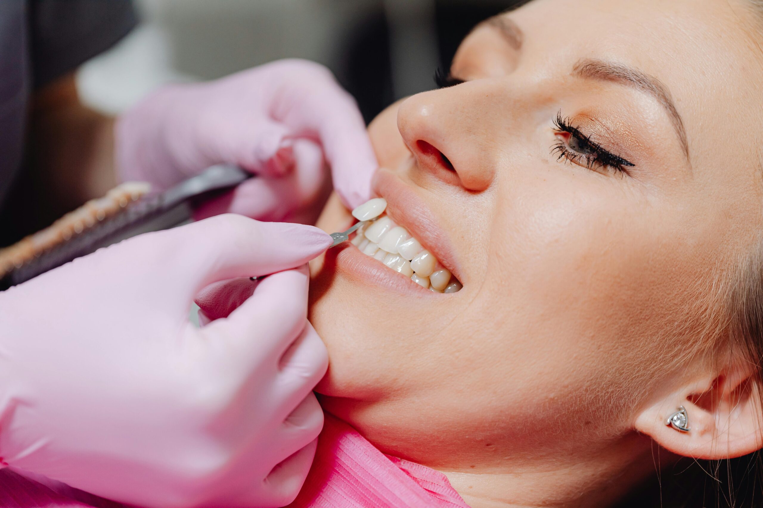 Porcelain Veneers in Dallas, TX