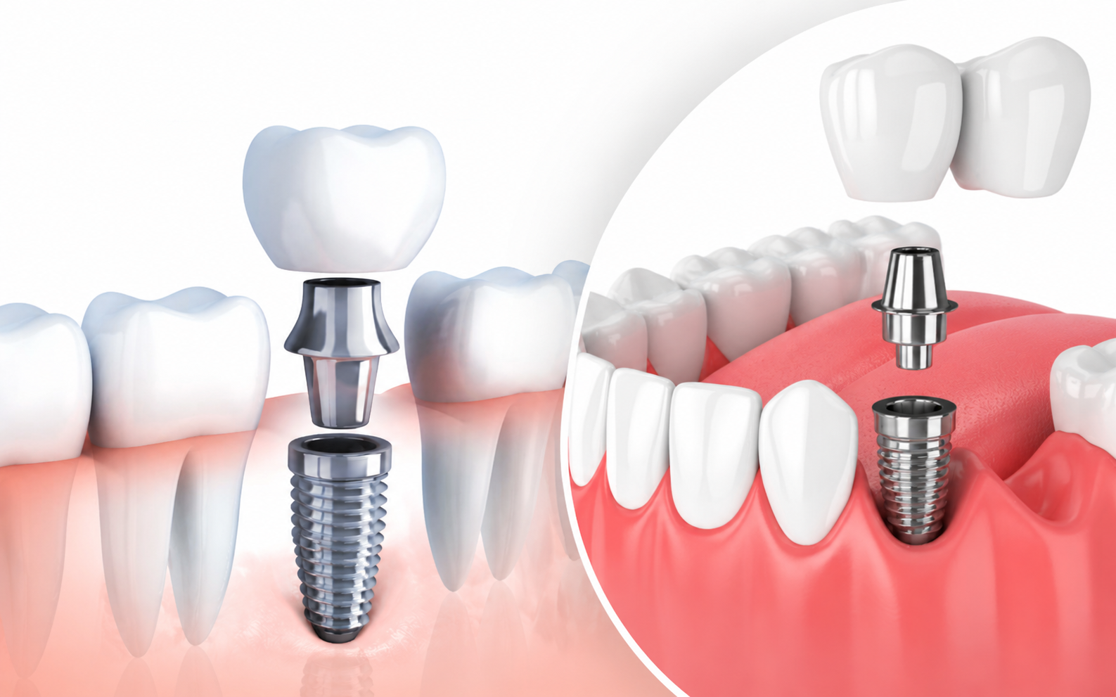 Dental Implants vs. Dental Bridges-